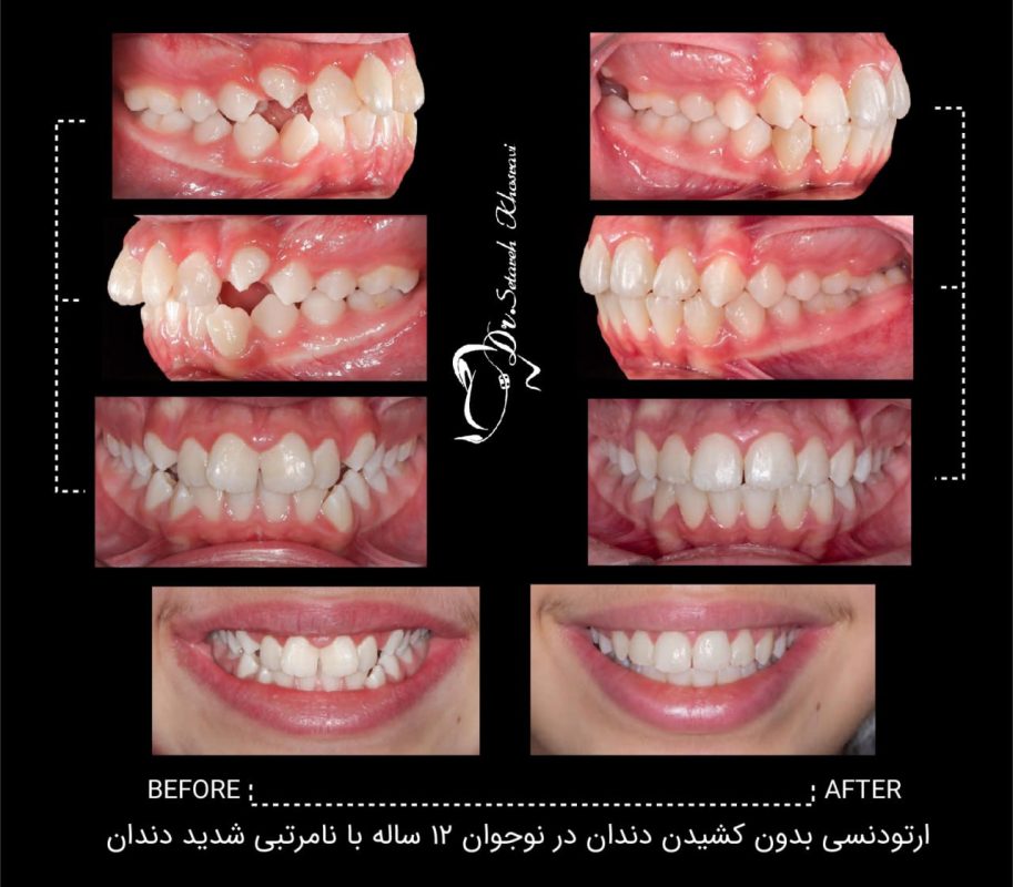 هزینه ارتودنسی نامرئی در سال 1404