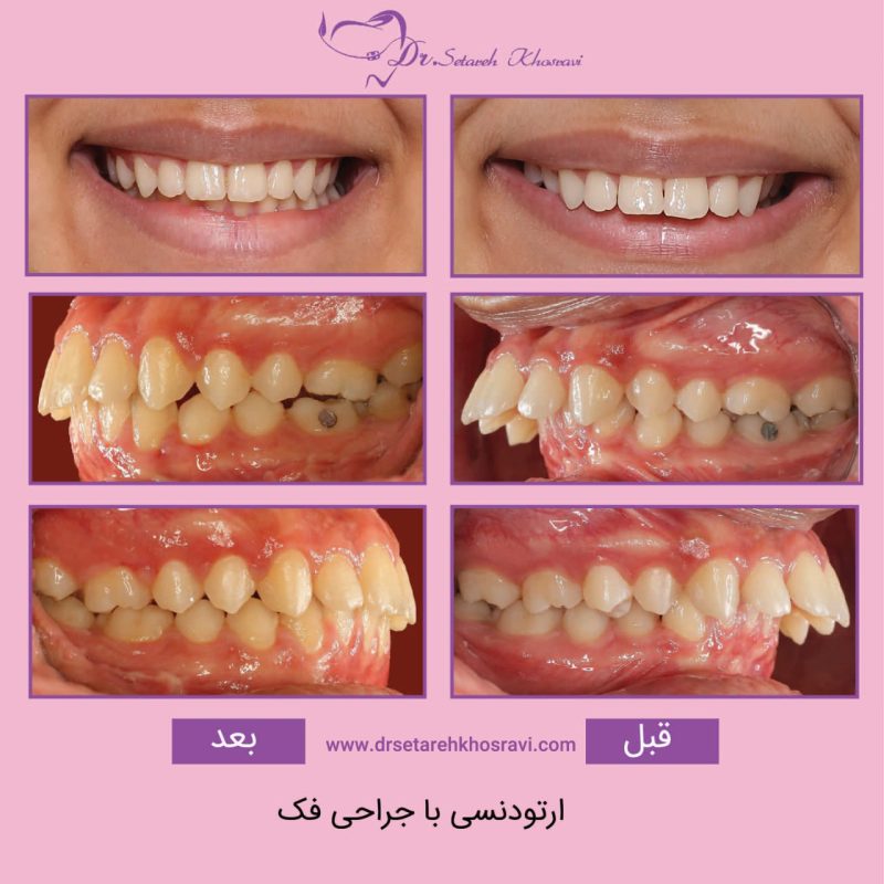 نمونه درمان ارتودنسی