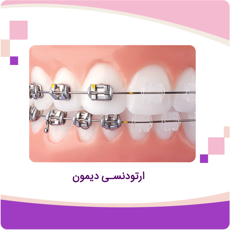 ارتودنسی دیمون
