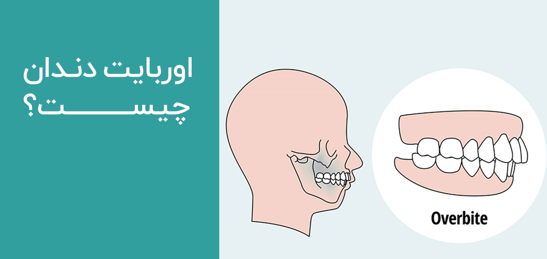براکت و بایت پلیت ارتودنسی