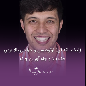 ارتودنسی و جراحی بالا بردن فک بالا