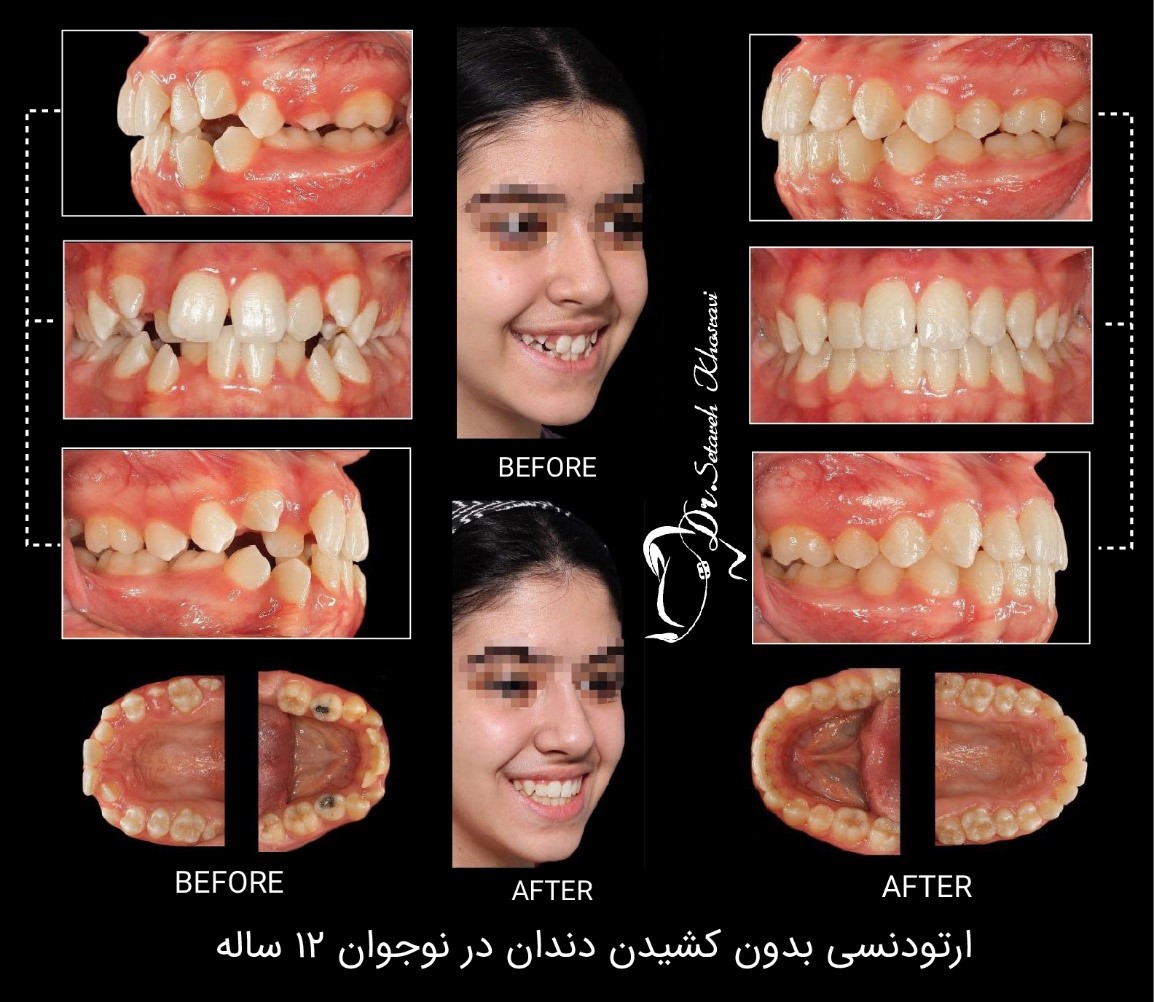 اصلاح طرح لبخند