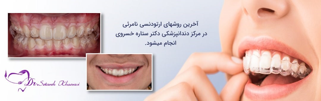 ارتودنسی نامرئی