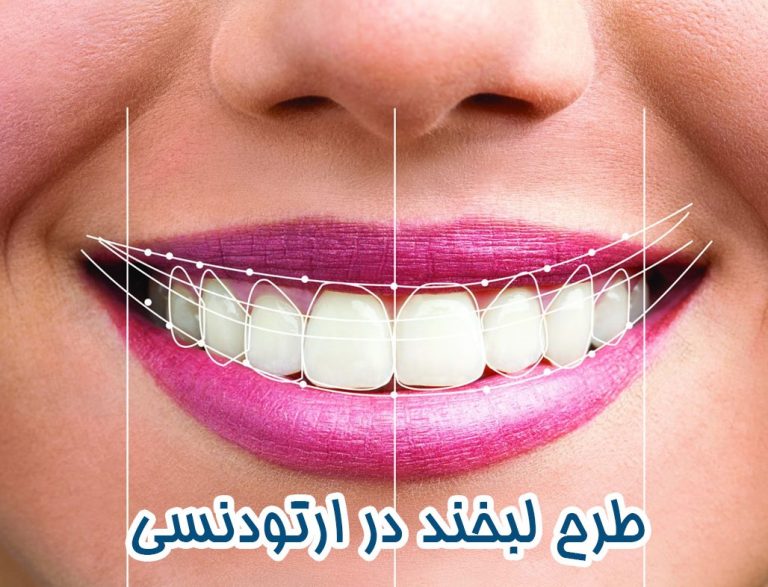 اصلاح طرح لبخند