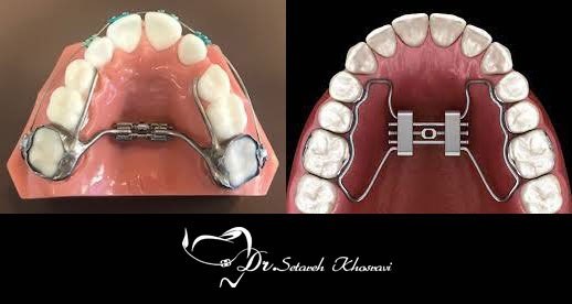 وسیع کننده کام یا اکسپندر: