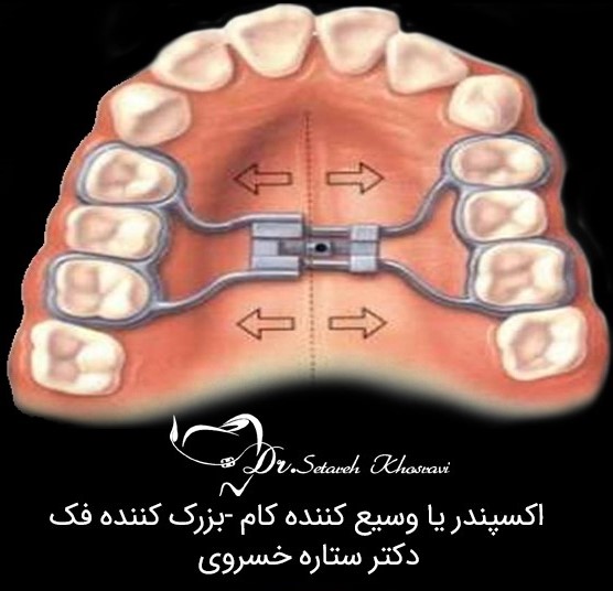 وسیع کننده کام
