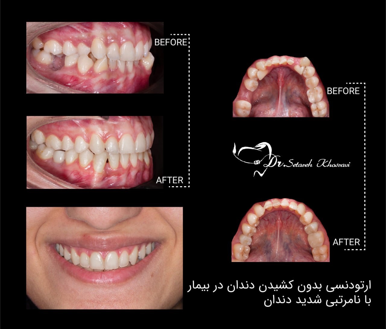 نامرتبی دندان ها - علائم ، علل و درمان
