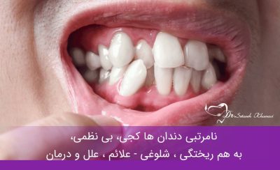 نامرتبی دندان ها - علائم ، علل و درمان