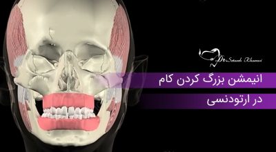 بزرگ کردن کام در ارتودنسی