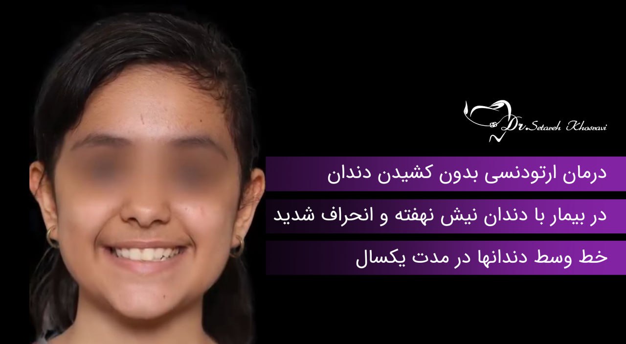 ارتودنسی بدون کشیدن دندان