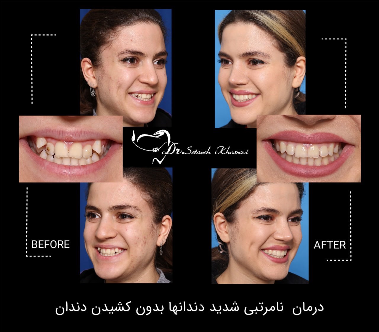 ارتودنسی بدون کشیدن دندان