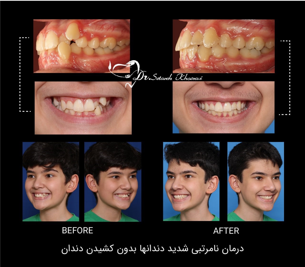 ارتودنسی بدون کشیدن دندان