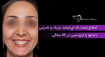 اصلاح لبخند لثه ای و نامرتبی دندانها با ارتودنسی