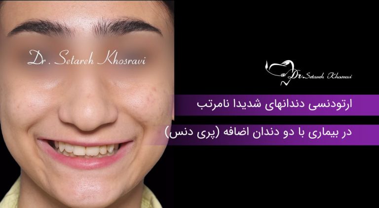 ارتودنسی دندانهای شدیدا نامرتب