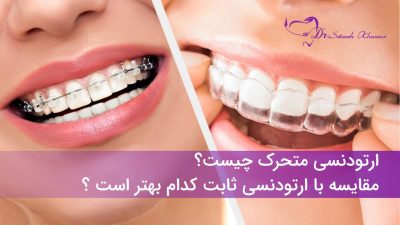 مقایسه ارتودنسی ثابت با ارتودنسی متحرک