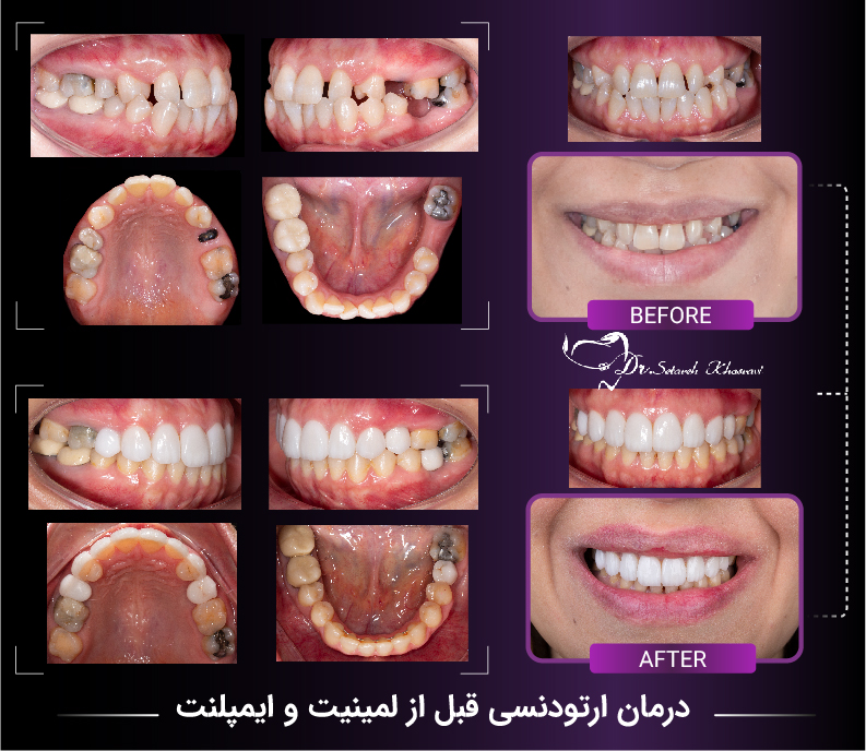 ارتودنسی قبل از لمینت