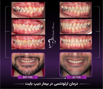دیپ بایت