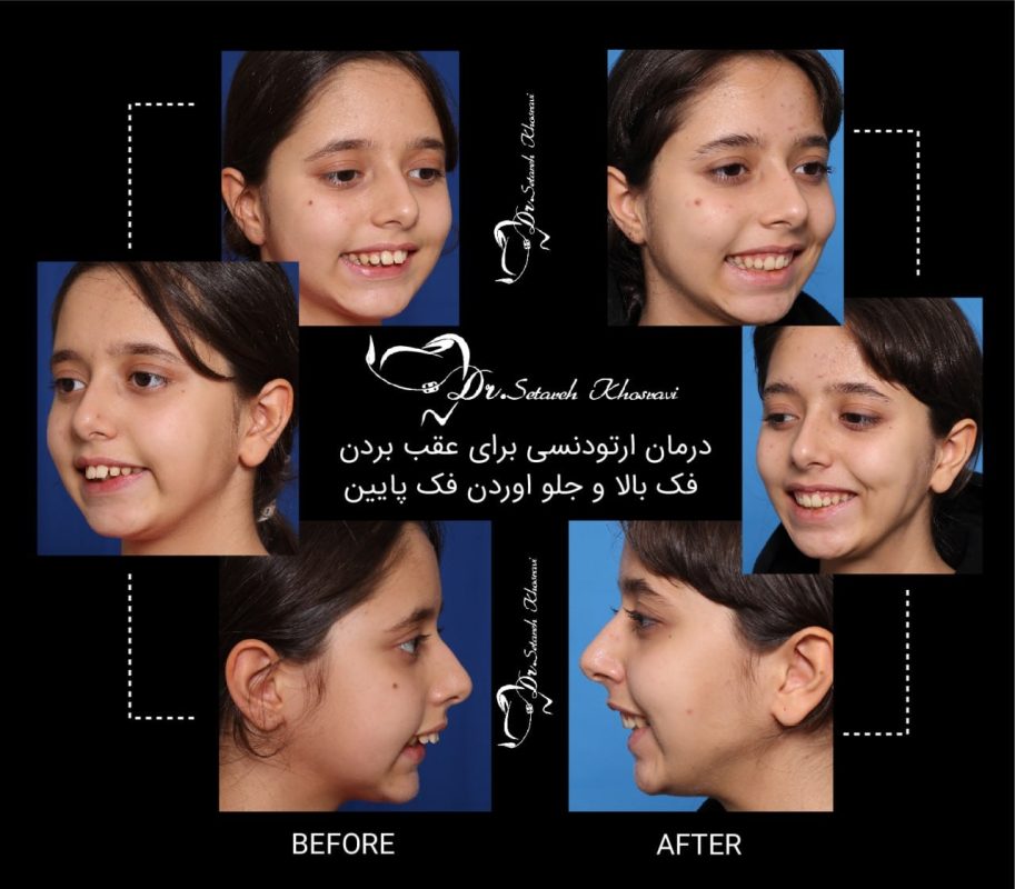 هزینه ارتودنسی نامرئی در سال 1404