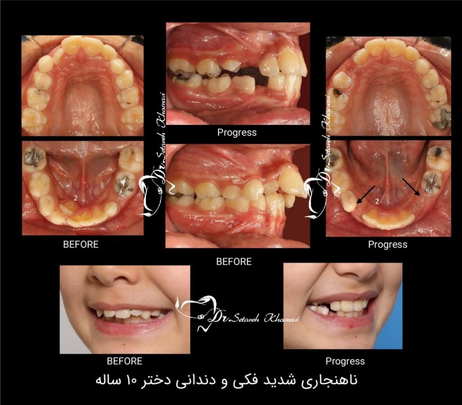 ارتودنسی کودکان زیر 10 سال
