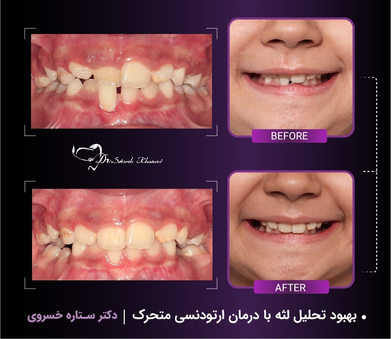 وسیع کننده کام یا اکسپندر