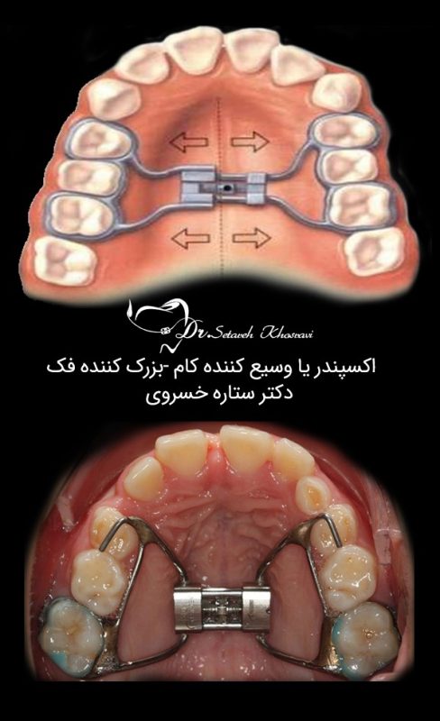 وسیع کننده کام یا اکسپندر