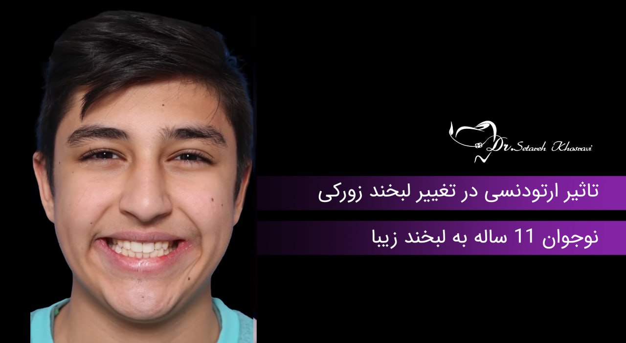 ارتودنسی کودکان زیر 10 سال