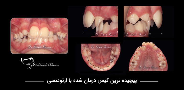 پیچیده ترین کیس درمان شده با ارتودنسی