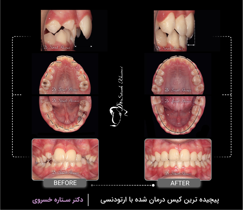 پیچیده ترین کیس درمان شده با ارتودنسی