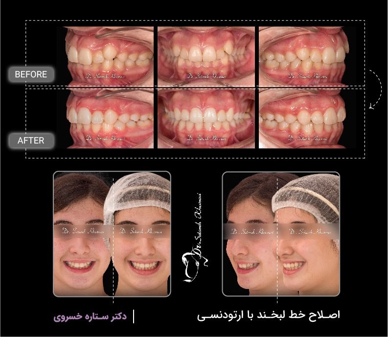 هزینه ارتودنسی در تهران