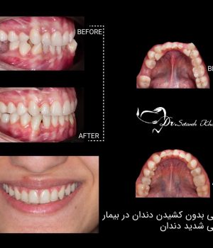 حلقه جدا کننده در ارتودنسی