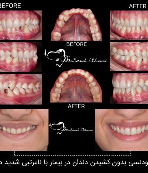 ارتودنسی بدون کشیدن دندان