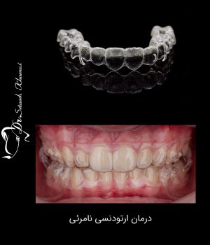ارتودنسی نامرئی