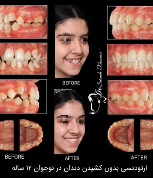 ارتودنسی بدون کشیدن دندان