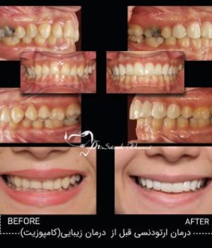 درمان ارتودنسی قبل از درمان زیبایی (کامپوزیت)