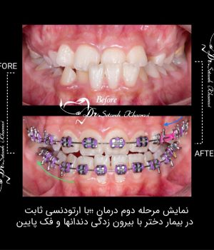 تارتودنسی ثابت