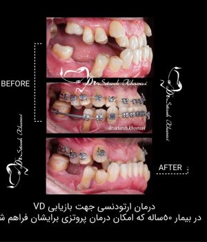 ارتودنسی بیمار 50 ساله